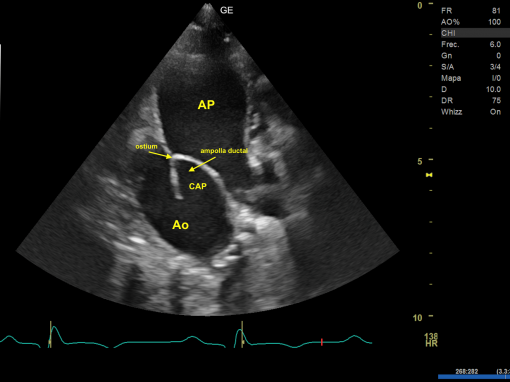 Conducto Arterioso Persistente